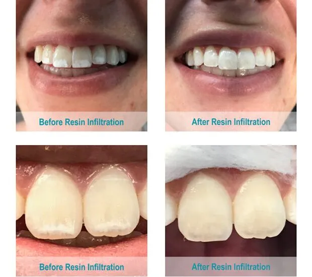 Icon resin infiltration treatment for white-spot lesions on a child's teeth